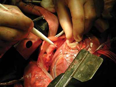 Heart Surgery In Oceania